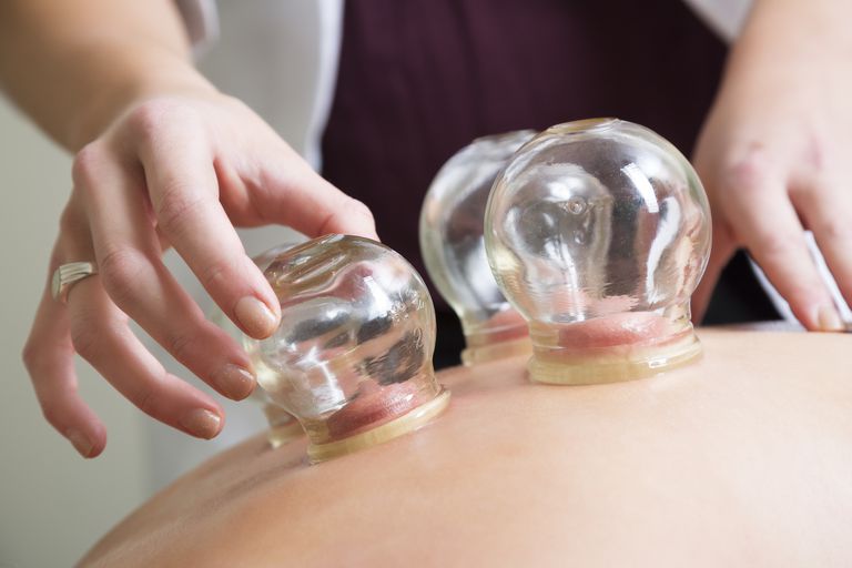 cupping therapy in forest hills queens ny