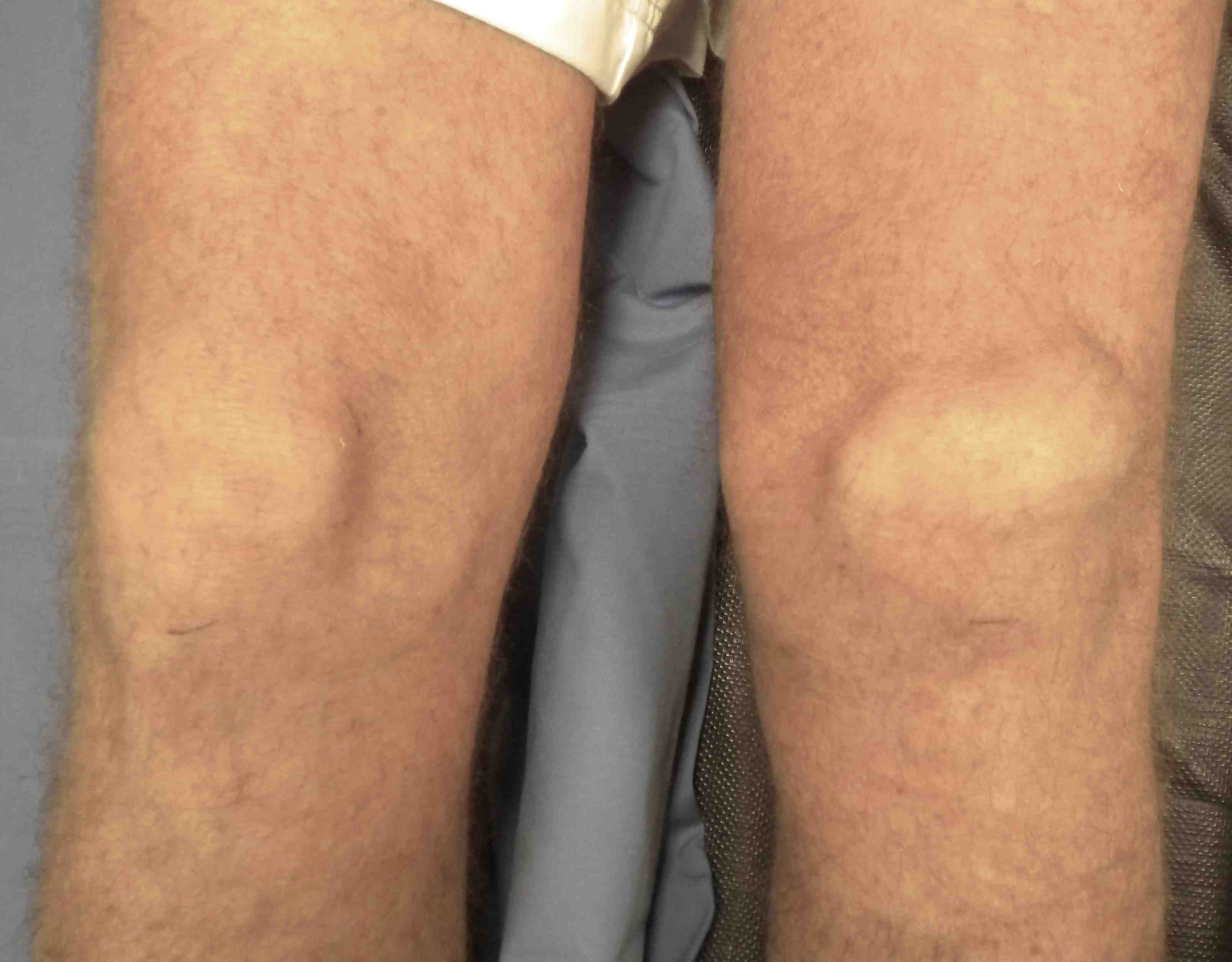 Quadriceps Tendon Tear - No Fault Doctor in Forest Hills, NY