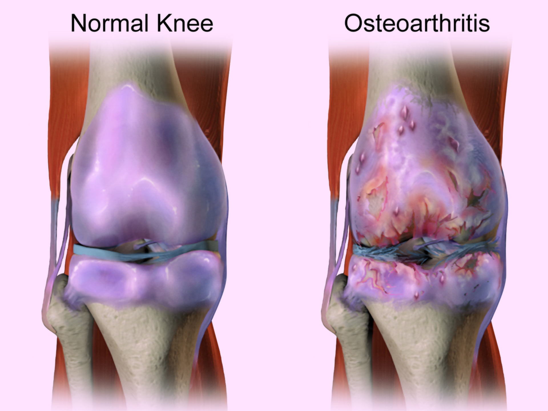 Synovial, role and management in non-inflammatory knee osteoarthritis