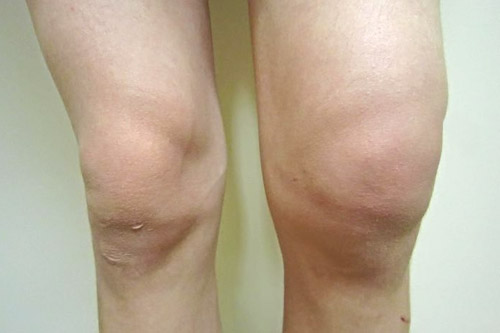 Knee Bursitis | Knee Bursitis Treatment - No Fault Doctor in Forest Hills