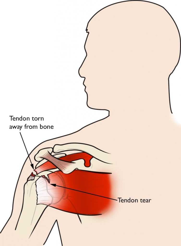 Rotator Cuff Injuries - No Fault Doctor in Forest Hills, Queens, NY